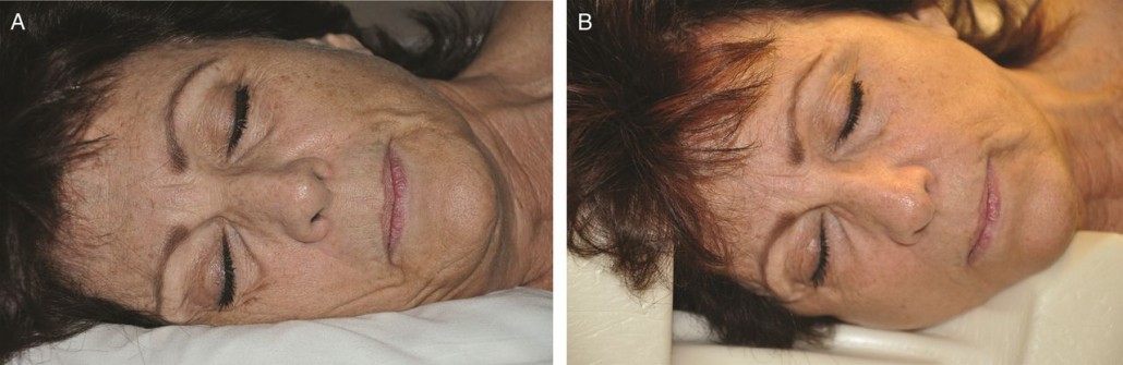 Diferencias de arrugas entre dormir sin almohada especial (izq.) y dormir con una almohada que minimice la compresión (dcha.)