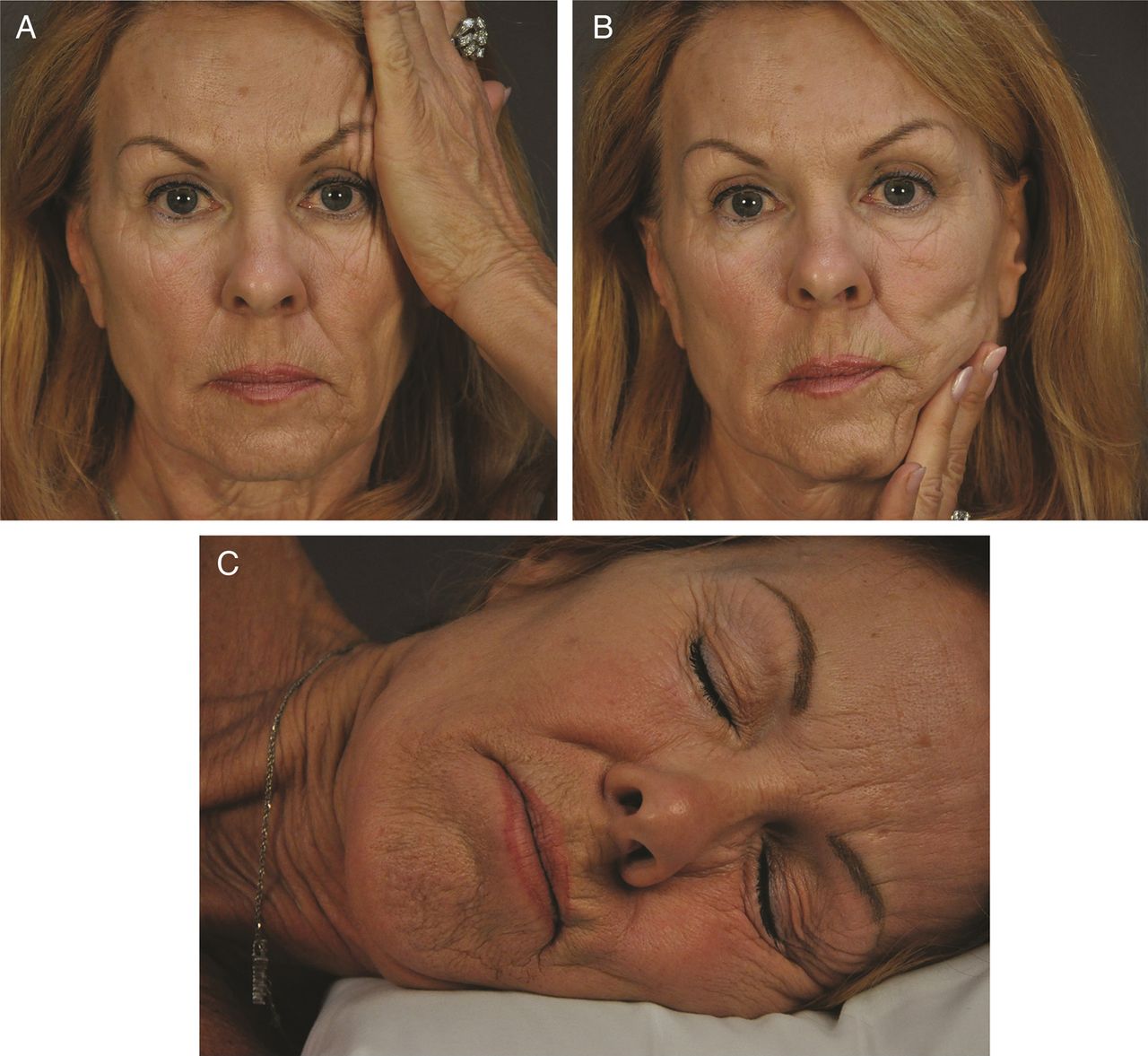 Recreación de la distorsión facial al dormir en una mujer de 65 años