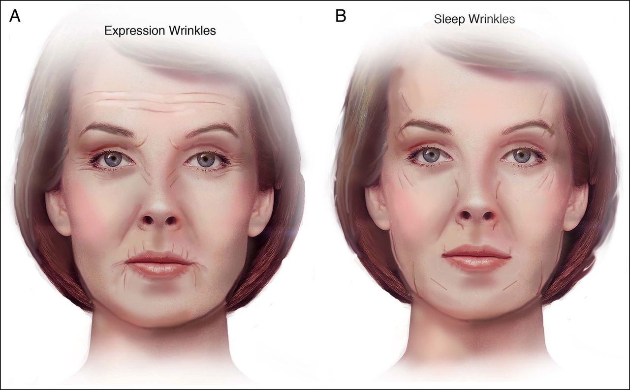 Diferencia entre las arrugas de expresión y las arrugas producidas por la posición al dormir